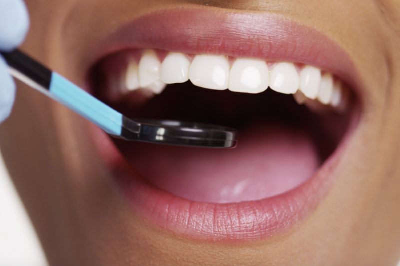 Dental check-up with mouth open and mirror.